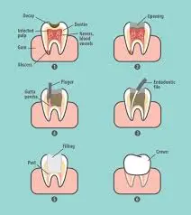 Root Canals, Upgraded