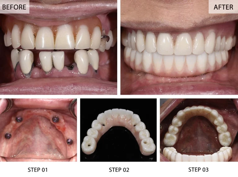 “Before and after comparison of All-on-4 dental implants restoration.”