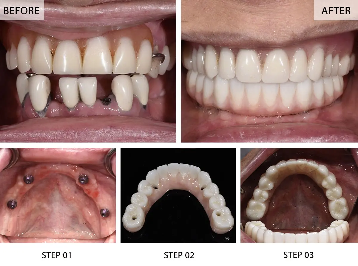 “Before and after comparison of All-on-4 dental implants restoration.”